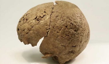 Madhara ya Ugonjwa wa Kaswende katika Mfumo wa Mishipa ya Fahamu (Neurosyphilis)
