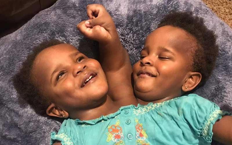 Je wajua sababu zainazopelekea mapacha kuzaliwa wameungana (Conjoined twins)