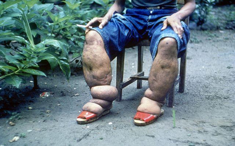 Ugonjwa wa Matende na Madhara yake (Elephantiasis)