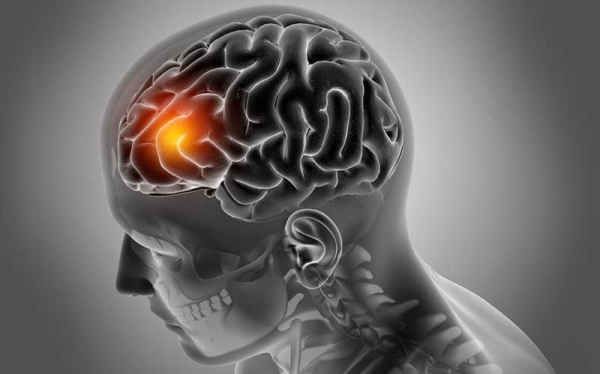 Ugonjwa wa saratani ya Ubongo (Brain Tumor). Chanzo, Dalili na Tiba