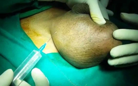Mabusha (Hydrocele): Ugonjwa au Ufahari?