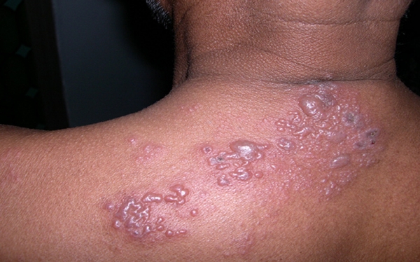 Mkanda wa Jeshi (Herpes Zoster/Shingles)