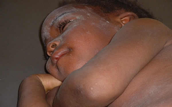 Ugonjwa wa Surua (Measles) - Dalili, Tiba na Kinga