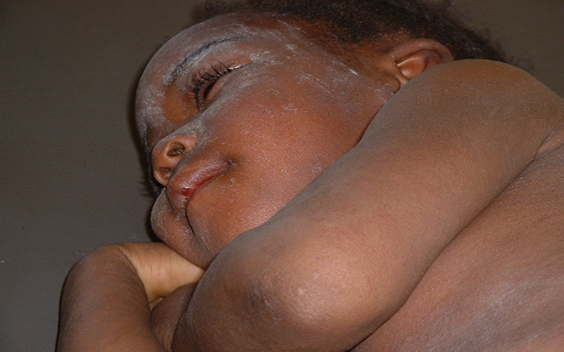 Ugonjwa wa Surua (Measles) - Dalili, Tiba na Kinga